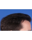 After Hair Transplant&nbsp;Hairlines